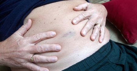 Stłuszczenie wątroby rozwija się powoli. Te owoce pomagają w regeneracji narządu