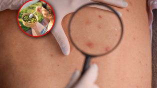 Dieta bogata w błonnik może wspomagać walkę z czerniakiem. "Nowe możliwości"