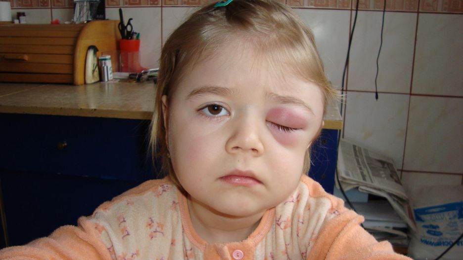 Dwunastoletnia Ola musi przyjmować cztery dawki Kineretu dziennie, inaczej choroba zagraża jej życiu