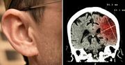 Naukowcy: wystąpienie udaru może zależeć od kształtu ucha