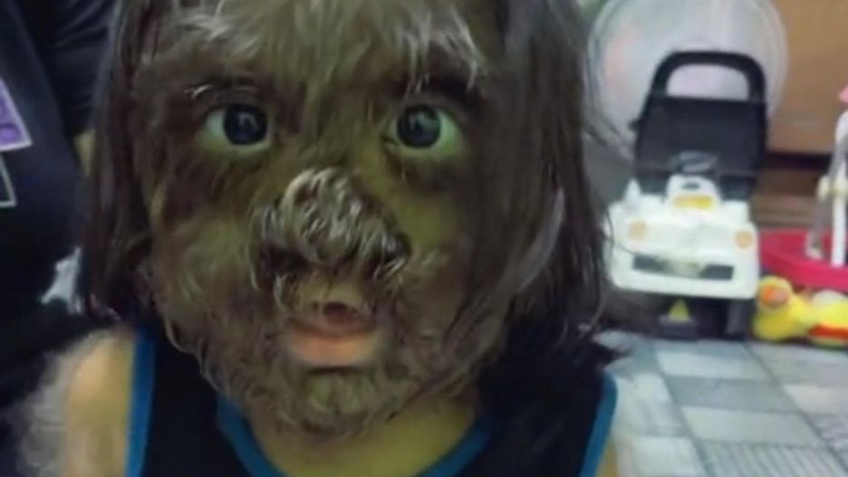 TikTokerka nagrywa filmy z dzieckiem, które cierpi na syndrom wilkołaka