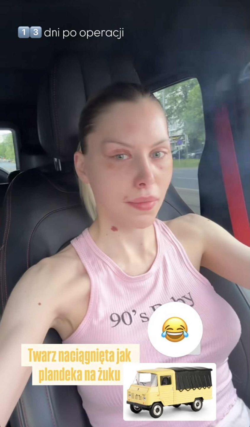 Julia von Stein pokazała zliftingowaną twarz 13 dni po operacji