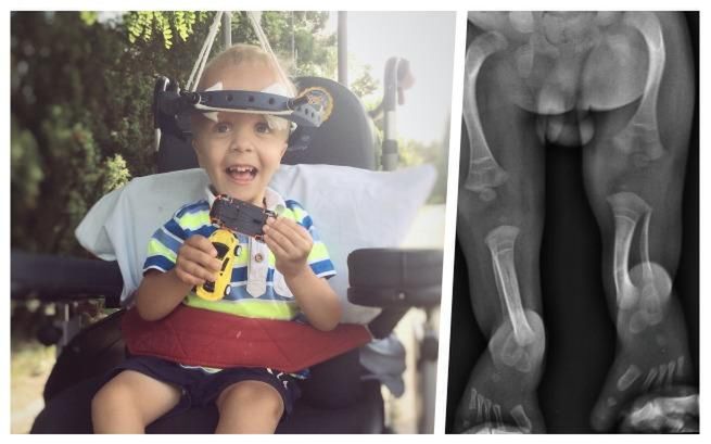 Adaś przeszedł już operację kręgosłupa i zabieg korekty stóp