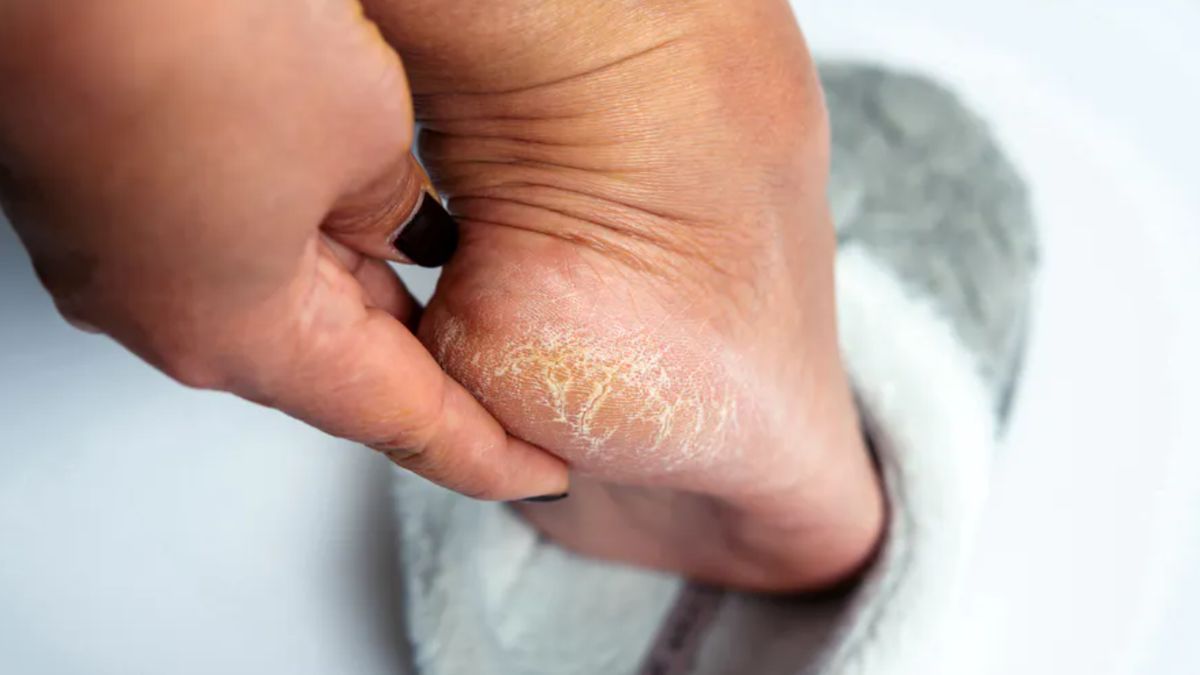 Trik na suche pięty