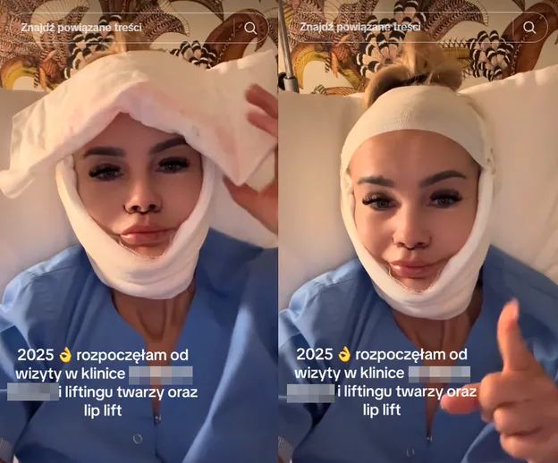 Monika Chwajoł po liftingu i lip lifcie