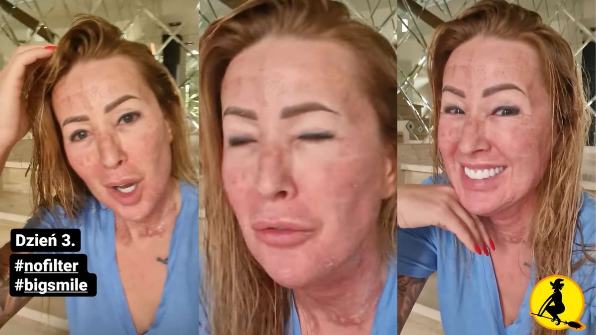 Sylwia Peretti pokazuje, jak wygląda progres po zabiegu laserowym za 6 tysięcy 