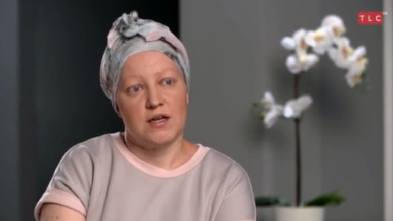 Włosy, brwi i rzęsy pani Marty zaczęły wypadać bez konkretnej przyczyny 