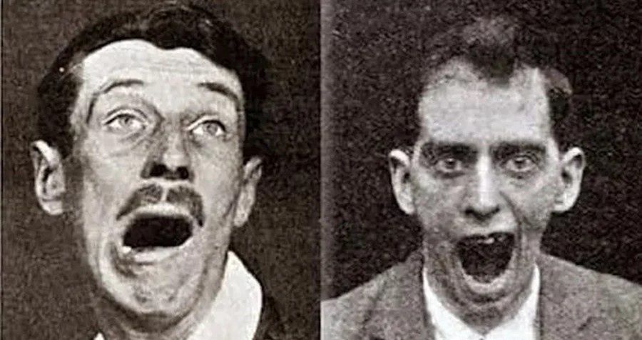 "Zombie" XX wieku. Choroba zamieniała ludzi w żywe posągi