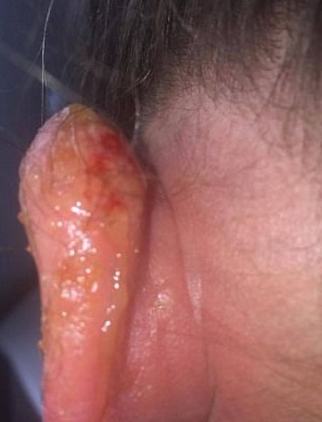 Ucho zaczęło puchnąć i ropieć