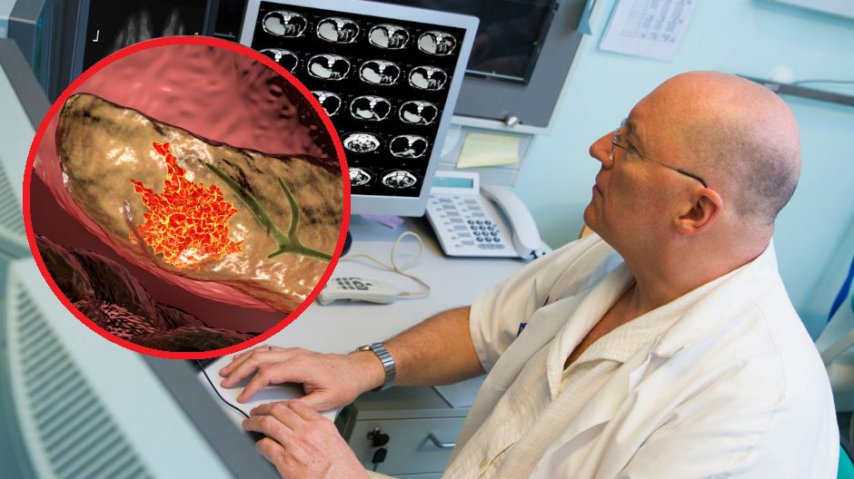 Rak trzustki jest jedną z najczęstszych przyczyn zgonów z powodu nowotworów na świecie