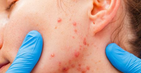 Dlaczego wycofano ponad 40 serii kremu Locacid?