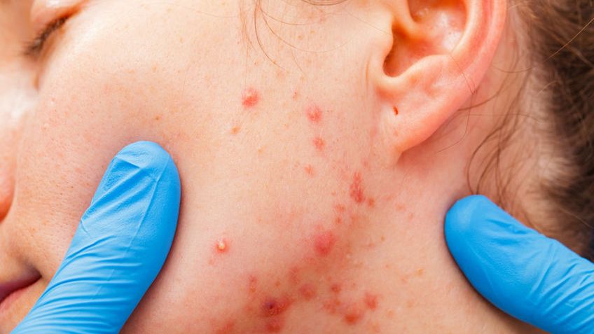 Locacid leczy trądzik.