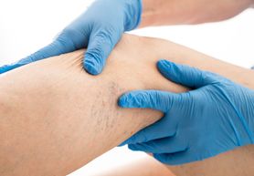 Diagnostyka zakrzepicy – objawy, D-dimery, badania dodatkowe