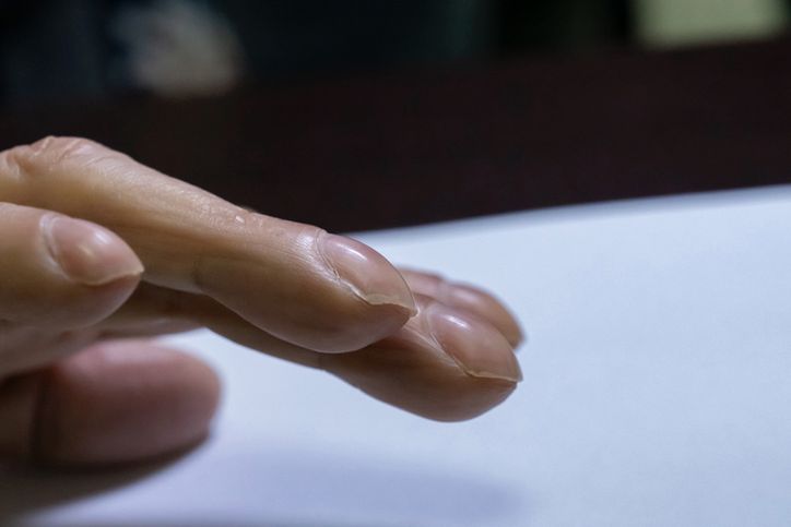 Deformacje dłoni wskazują na problemy zdrowotne