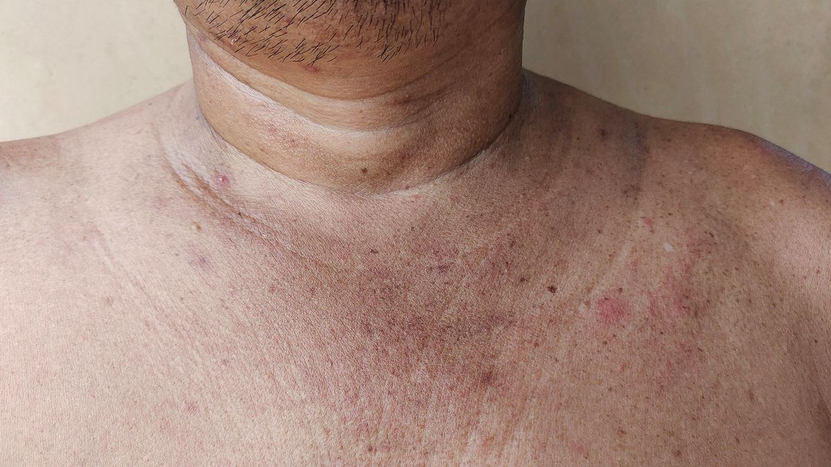 Może pojawiać się, gdy wysoki cukier szaleje we krwi. Łatwo przegapić pierwsze objawy