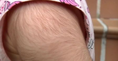 Na ciele dzieci wyrastają włosy jak u wilkołaków. Wszystko przez pomylony lek