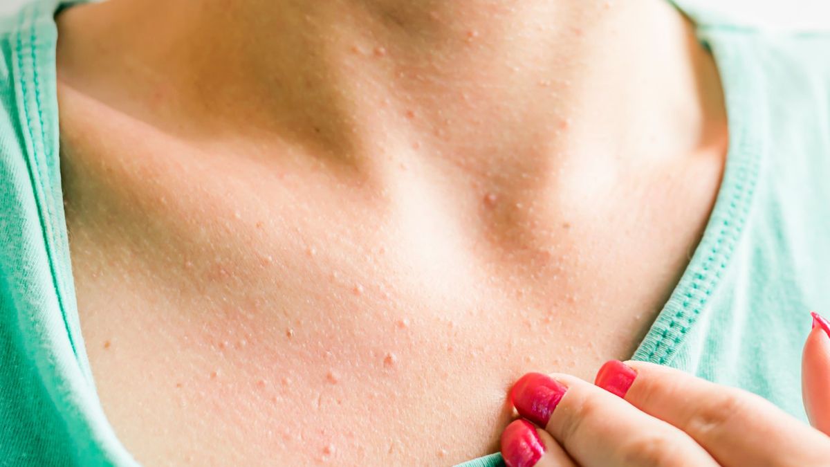 Krostki na dekolcie mogą być spowodowane różnymi czynnikami np. alergią pokarmową.