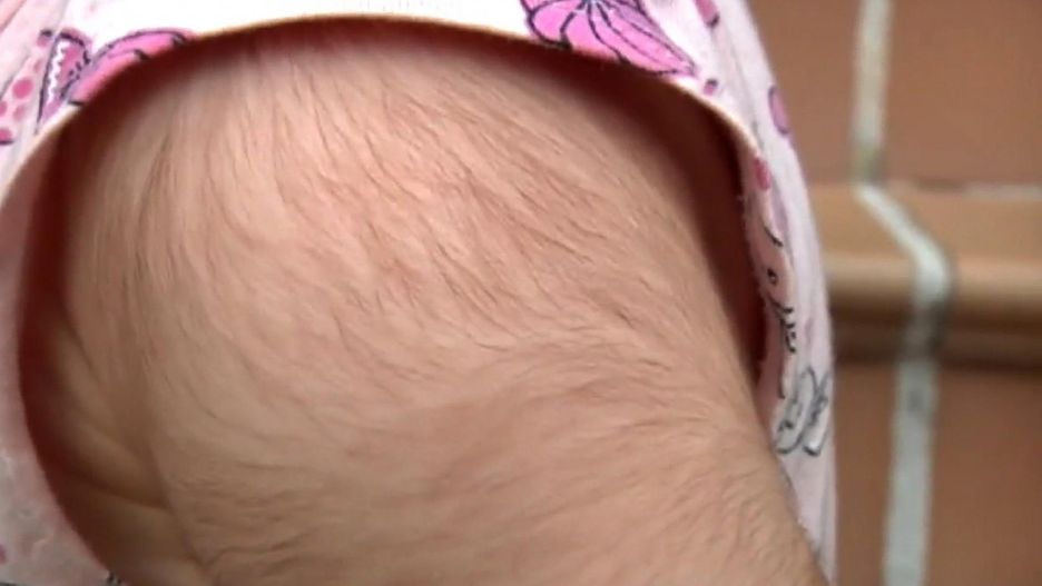 Ciało dziecka, które zażywało minoksydyl