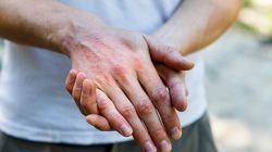 Elidel - działanie, wskazania i przeciwwskazania