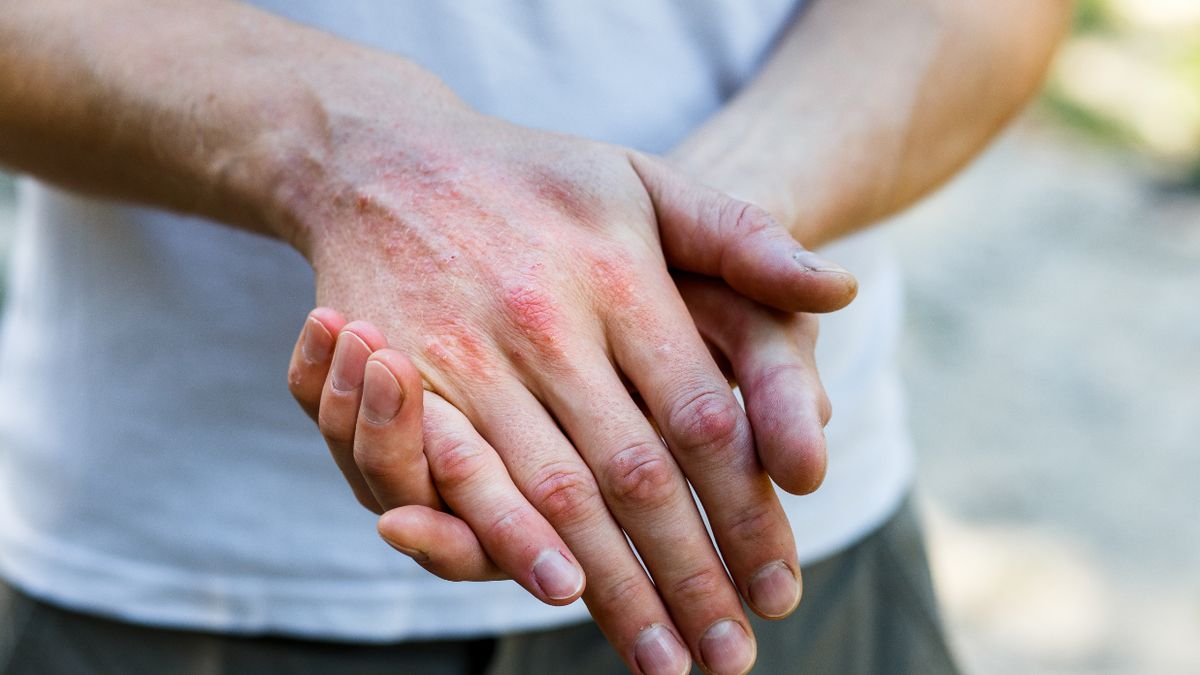 Elidel krem to lek na atopowe zapalenie skóry u dzieci i dorosłych.