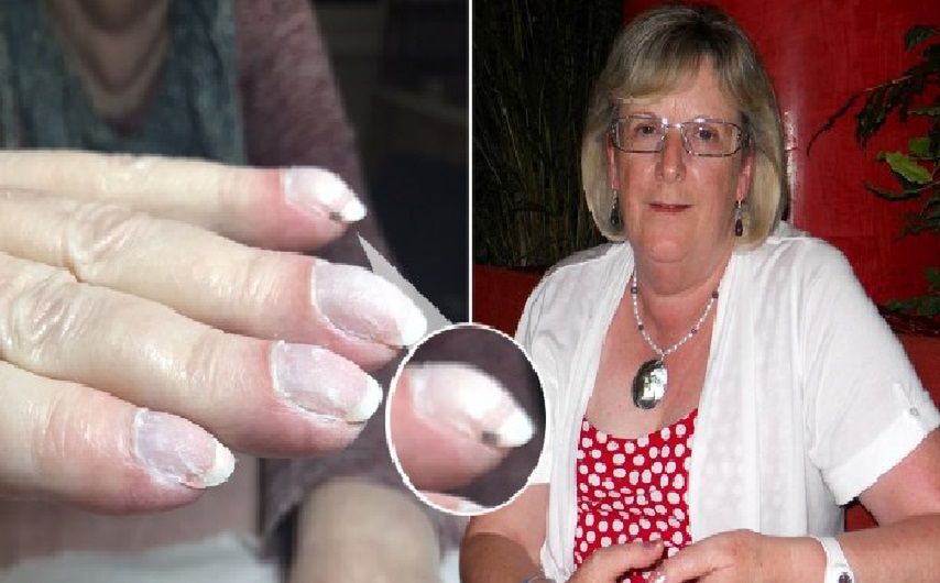 Zmiany na paznokciu objawem nowotworu płuc