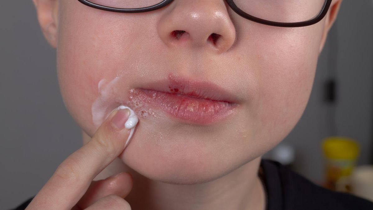 Jak leczyć opryszczkę?