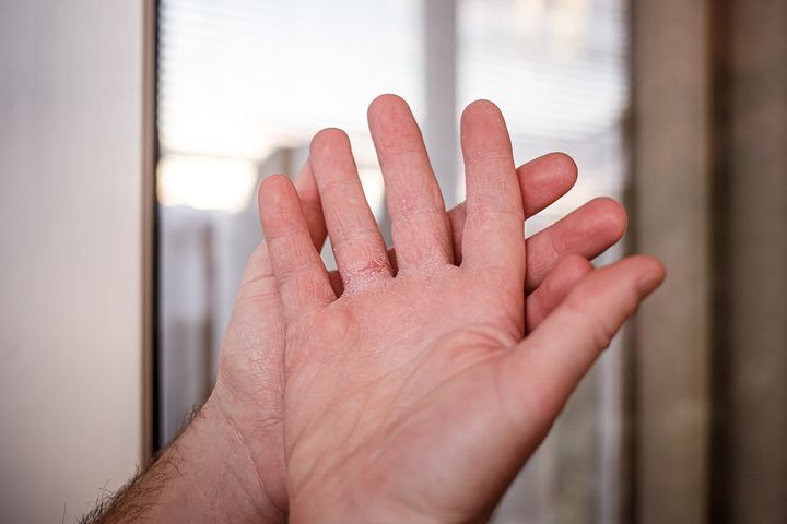 Drętwienie i mrowienie dłoni może mieć wiele przyczyn. Kiedy parestezje powinny zaniepokoić?