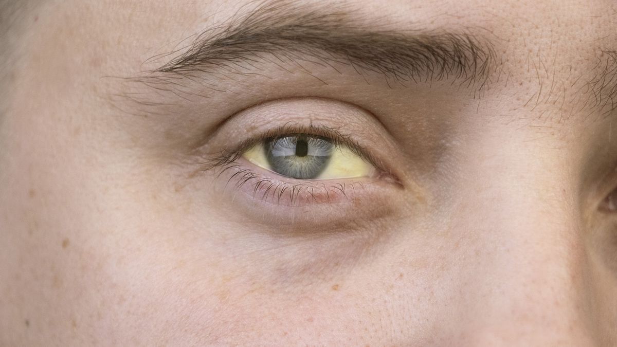 Jakie objawy daje rak płuc?