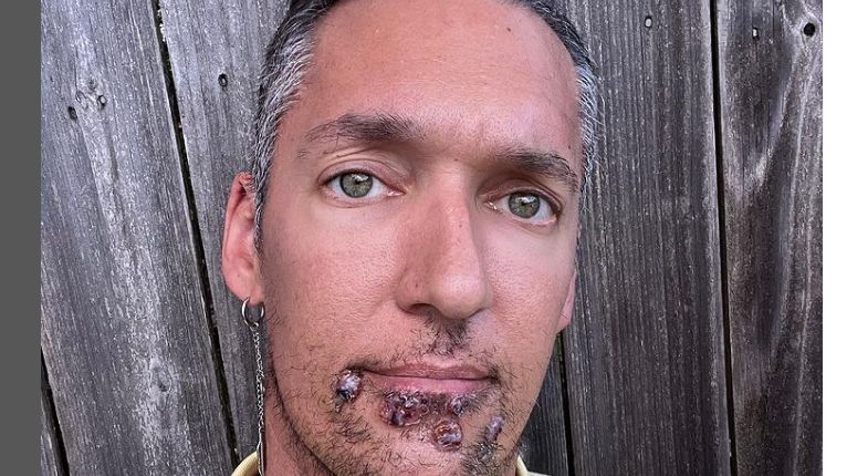 Zachorował na małpią ospę. Pokazuje jak rozwijają się objawy wirusa