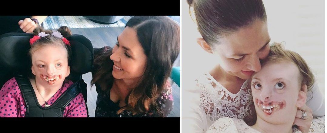 Zdjęcie Sophie Weaver wykorzystano, aby promować aborcję. Dziewczynka chora na zespół Retta nie żyje