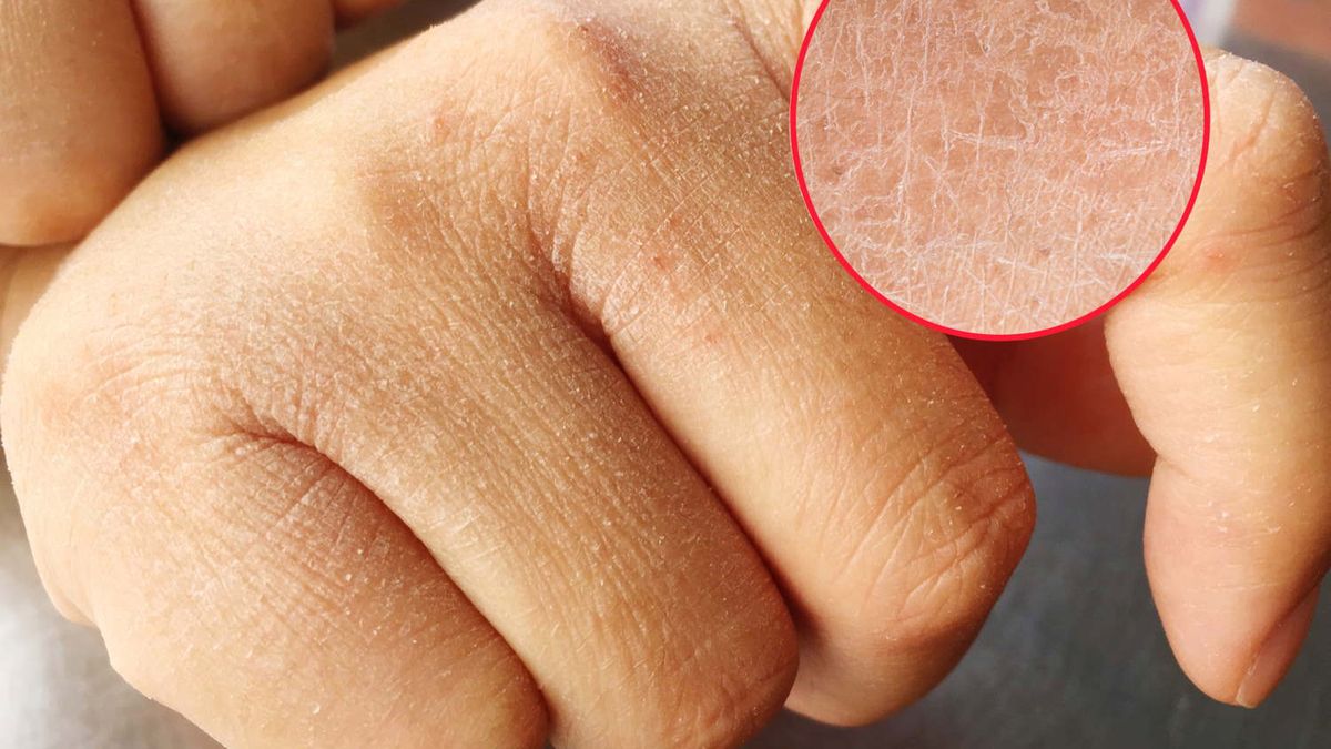 Wyschnięta i pomarszczona skóra to objaw chorej wątroby