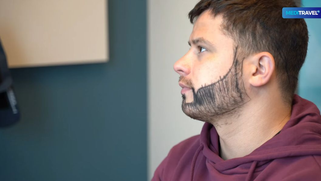 Rafał Collins przeszczepił włosy na brodzie