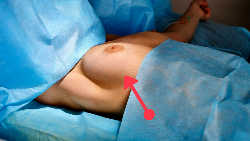 Lisa Royle i zmiany nowotworowe na piersi