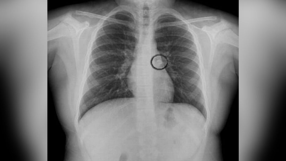 Dziewczynce wypadł ząb. Przez sen wciągnęła go do oskrzeli