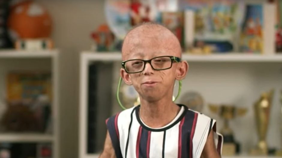 Chłopiec z progerią.