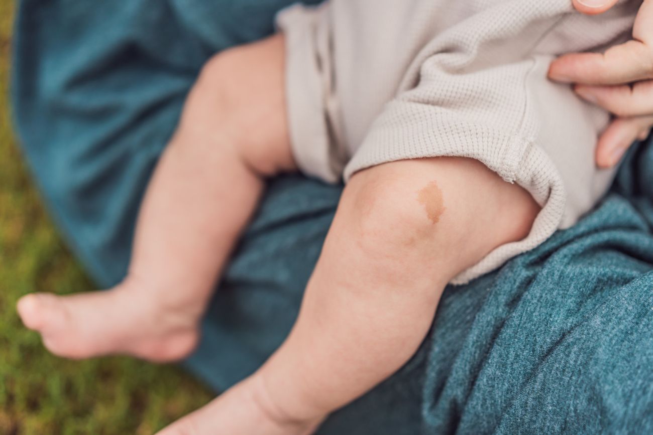 Znamiona mogą pojawiać się bezpośrednio po urodzeniu