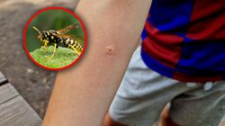 Niebezpieczne ukąszenie szerszenia, osy i pszczoły. Może wywołać wstrząs anafilaktyczny