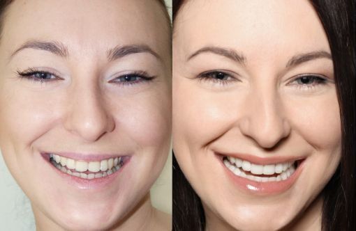 Bonding – metamorfoza zębów