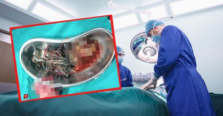 Bolał go brzuch. Lekarze osłupieli. Znaleźli 60 przedmiotów w mężczyźnie