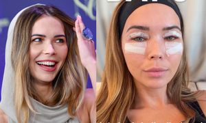 Sandra Kubicka nadaje do fanów TRZY DNI po operacji plastycznej: "Nie mogę otworzyć OCZU W PEŁNI" (FOTO)