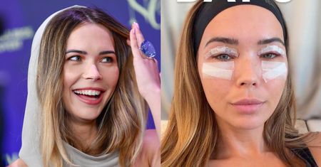 Sandra Kubicka nadaje do fanów TRZY DNI po operacji plastycznej: "Nie mogę otworzyć OCZU W PEŁNI" (FOTO)