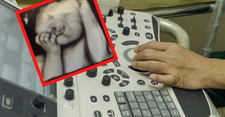 Płód miał rozszczep wargi. Przyszła mama odmówiła aborcji