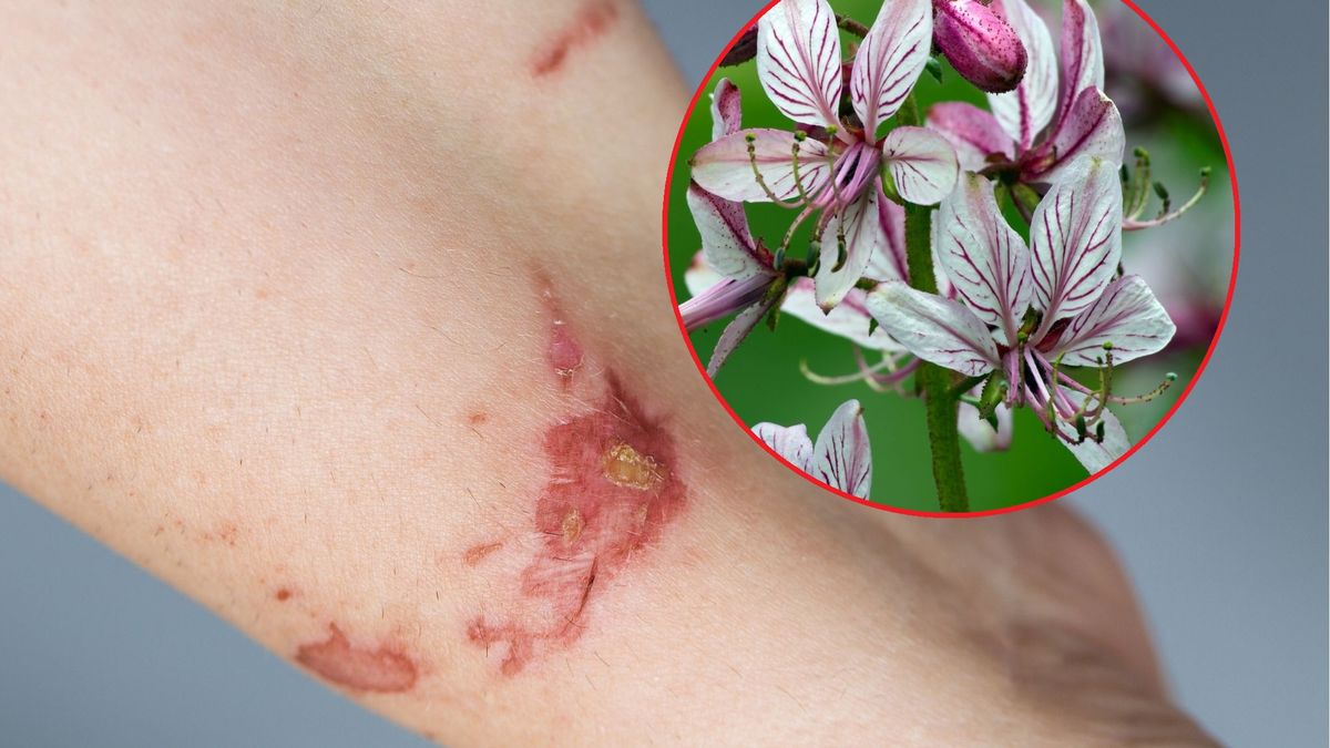 Dyptam może powodować bolesne oparzenia