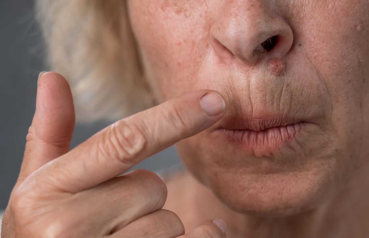 Smoker's wrinkles: 80p cream with vitamins offers an affordable fix