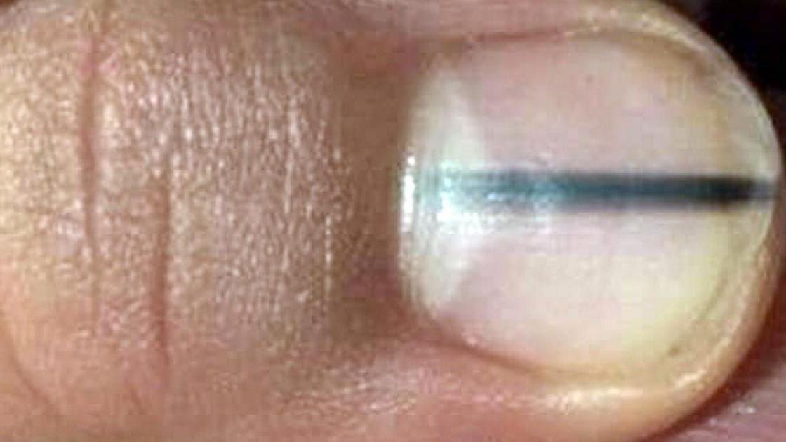 Chory paznokieć kobiety