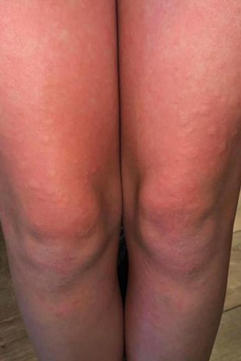 Nastolatka jest tak uczulona na zimno, że zimą ledwo może wyjść z domu