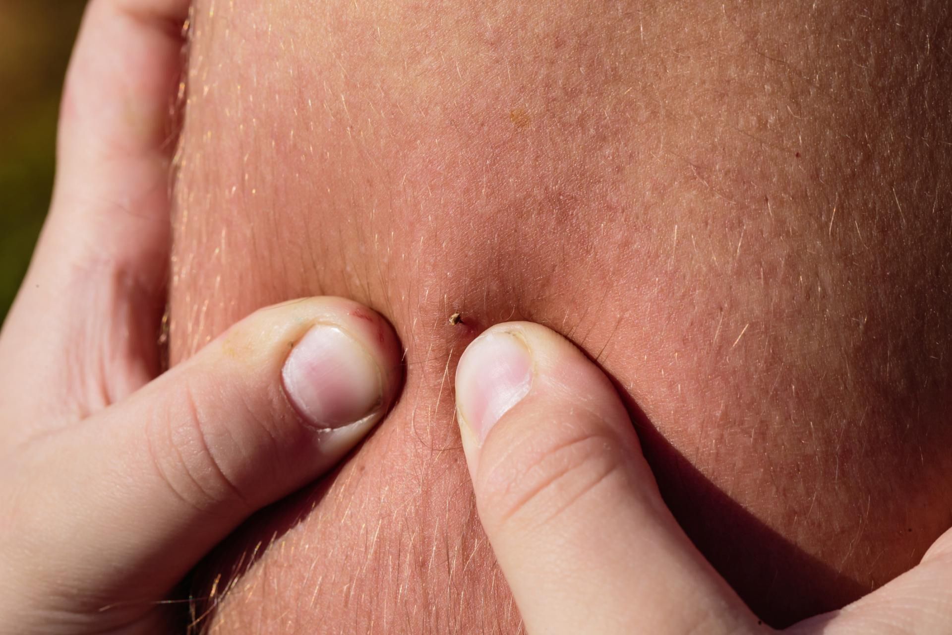 Pszczoła pozostawia w skórze widoczne żądło