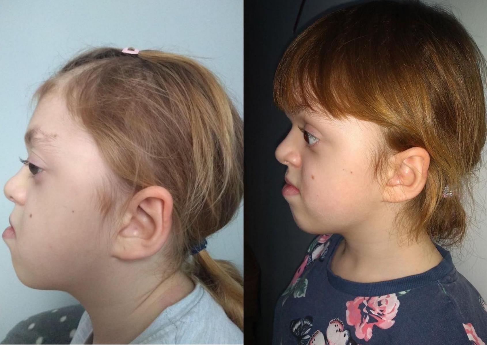 Ania przed i po operacji