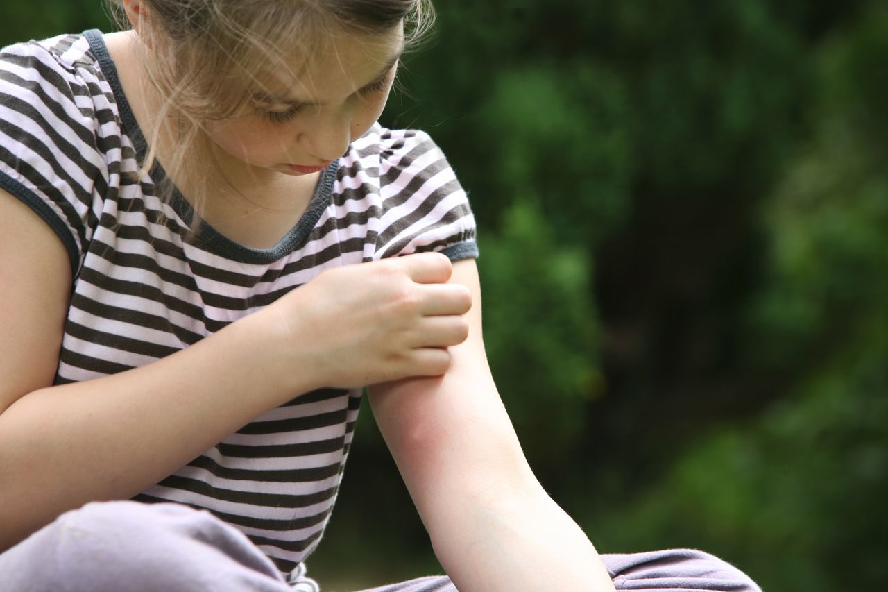 Naturalne metody pomogą złagodzić skutki ukąszenia komara
