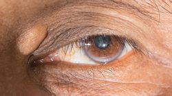 Kępki żółte zwiastunem zawału. Nowe badania